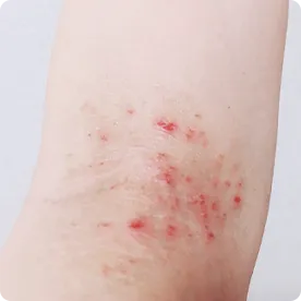 皮膚病