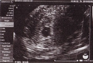 妊娠エコー写真胎嚢