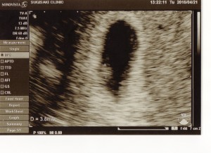 2015年4月21日撮影胎児エコー写真
