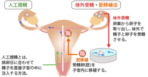 人工授精、体外受精