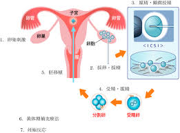 顕微授精