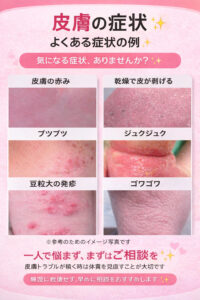 🌿 アトピー性皮膚炎の中医診療と漢方「症状」ではなく「あなたの体」を診る