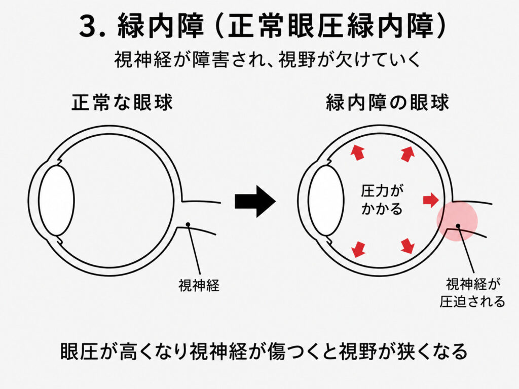 緑内障(正常眼圧緑内障)